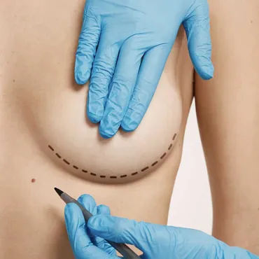 Marcação pré-operatória de mamoplastia